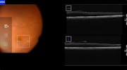 Intra-operative OCT