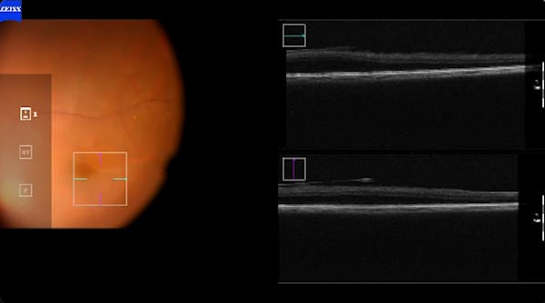 Intra-operative OCT thumbnail