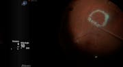 Extra-Large Macular Hole