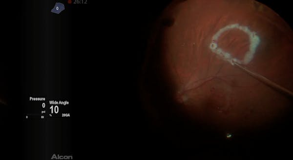Extra-Large Macular Hole thumbnail