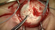Scleral Buckling