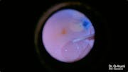 Optic Nerve Pit