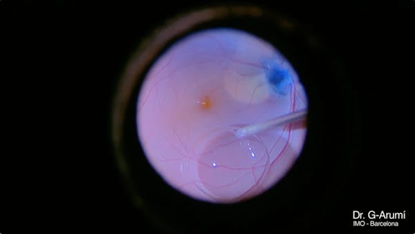 Optic Nerve Pit thumbnail