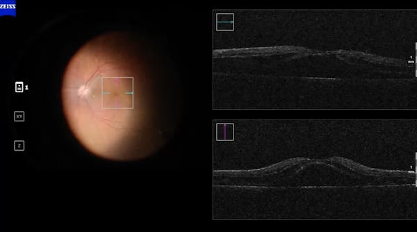 Subretinal Fluid Drainage thumbnail
