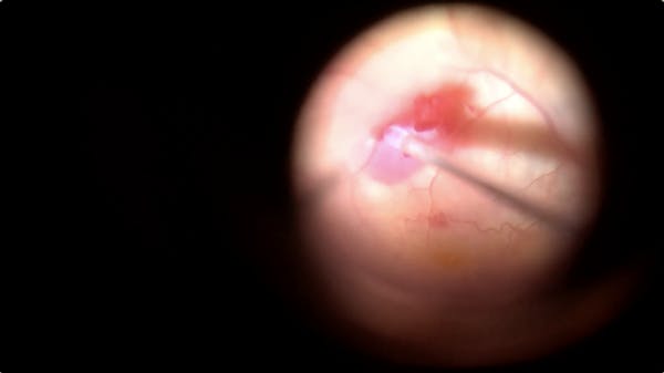ILM Peeling thumbnail