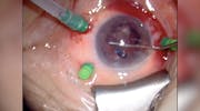 Cataract Surgery