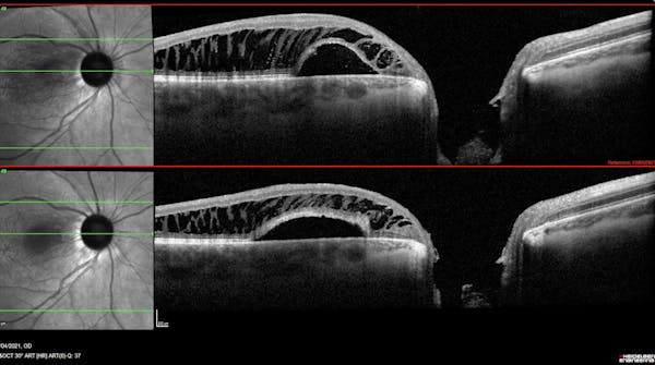 Optic Nerve Pit thumbnail