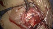 Scleral Buckling & Chanelier Lighting