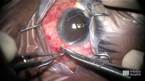 Minimizing Risks During Tube Shunt Surgery in Sturge-Weber Syndrome