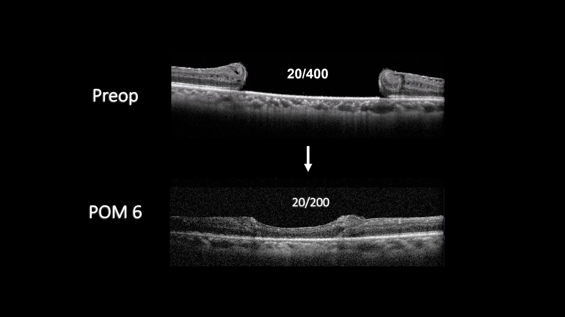 Autologous Transplant and Retinal Detachment Repair - Eyetube