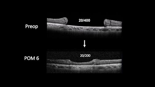 Autologous Transplant and Retinal Detachment Repair