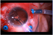 Aniridia and Oil