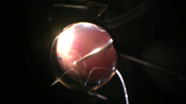 Vitreous Incarceration thumbnail