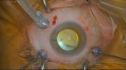 Deformed IOL