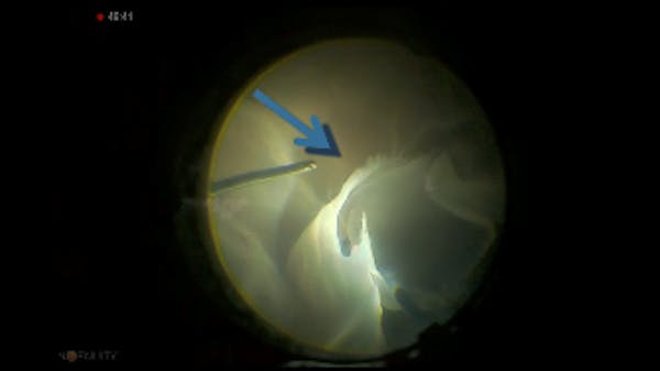 Iatrogenic Break thumbnail