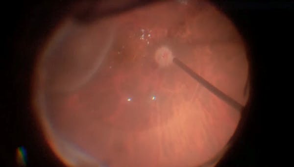 Subretinal Perfluoron thumbnail