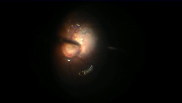 Optic Nerve Pit and Subretinal Oil thumbnail