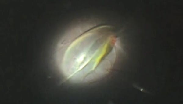 Macular Fold thumbnail