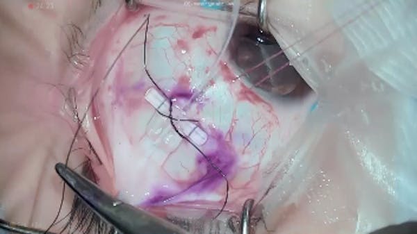Macular Detachment in S-cone Syndrome thumbnail