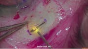 Susvimo: Surgical Pearls & Tricks #2 (Scleral incision and laser)