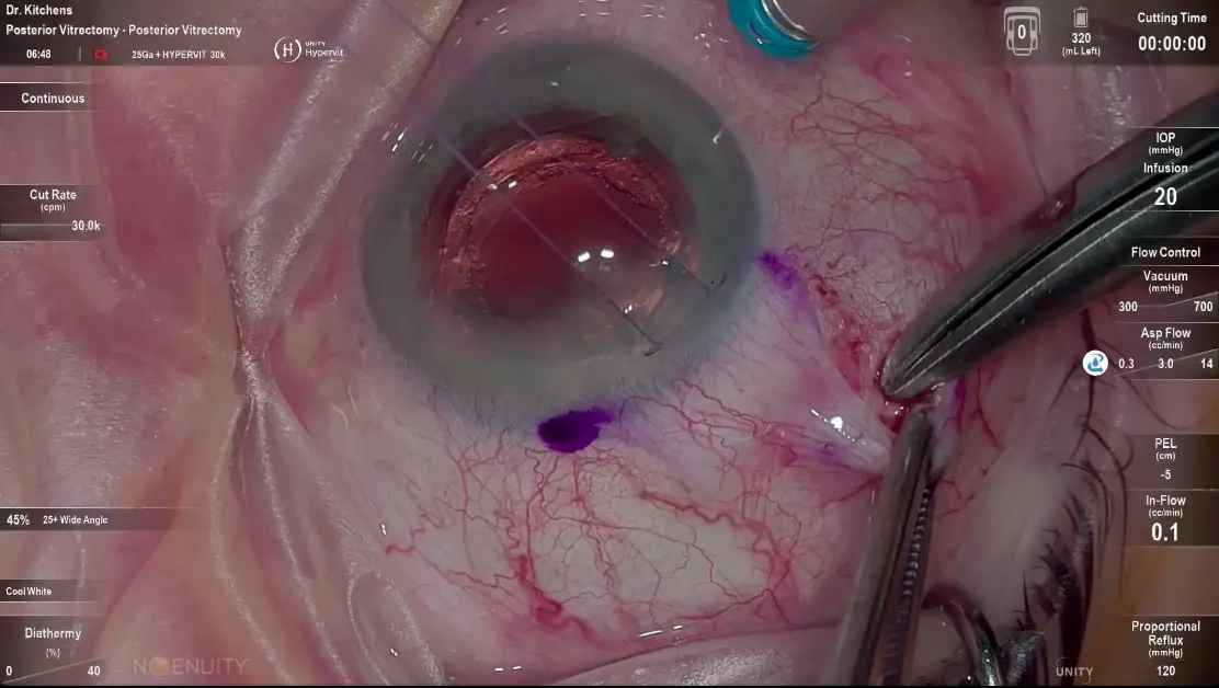 Susvimo: Surgical Pearls - Conjunctival Peritomy, Scleral Incision ...