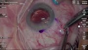 Susvimo: Surgical Pearls - Conjunctival Peritomy, Scleral Incision