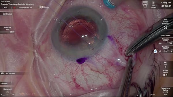 Susvimo: Surgical Pearls - Conjunctival Peritomy, Scleral Incision thumbnail