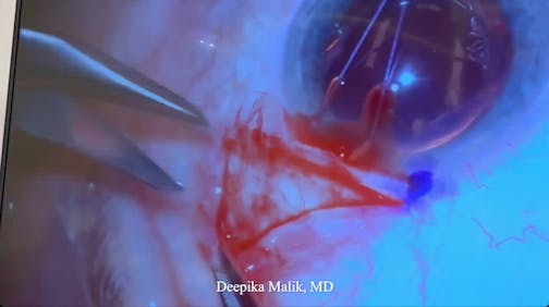 Susvimo: Surgical Pearls & Tricks #1