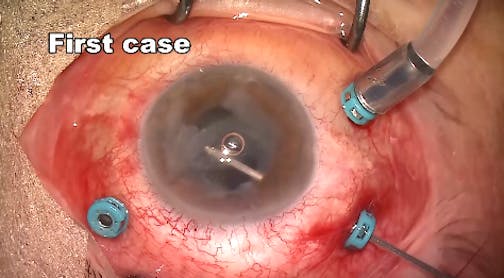 Intracameral Antibiotics