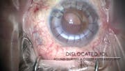 Dislocated IOL