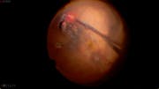Myopic Detachment