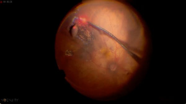 Myopic Detachment thumbnail