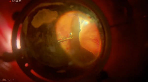 Iatrogenic Break thumbnail