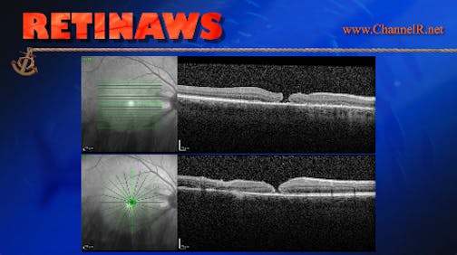 PFCL Induced Macular Hole