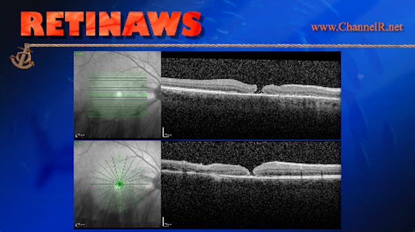 PFCL Induced Macular Hole thumbnail