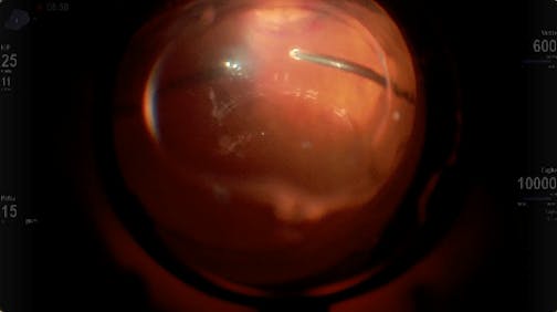 Vitrectomy Under Air