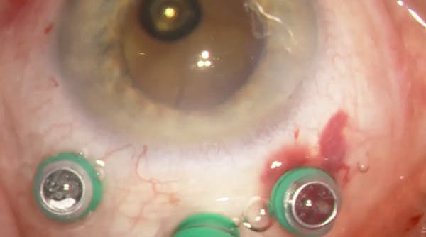 Nanophthalmos thumbnail