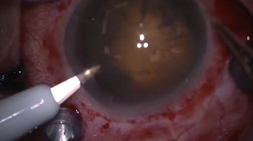 Retinoschisis & Retinal Detachment