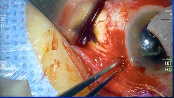 Suprachoroidal Hemorrhage thumbnail