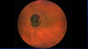 Submacular Hemorrhage