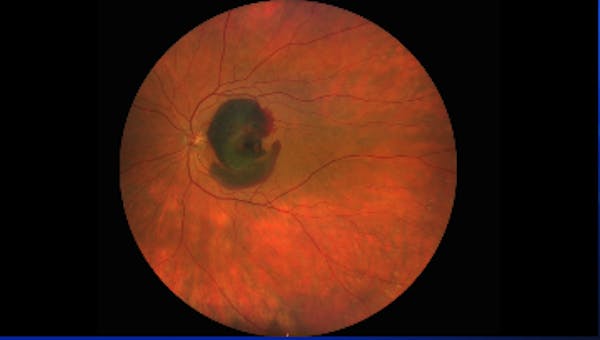 Submacular Hemorrhage thumbnail