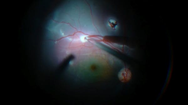 Subretinal Hemorrhage thumbnail