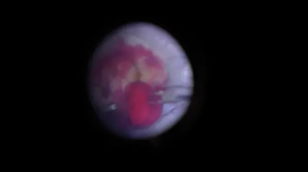 Hemorrhage thumbnail