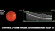Macular Fold