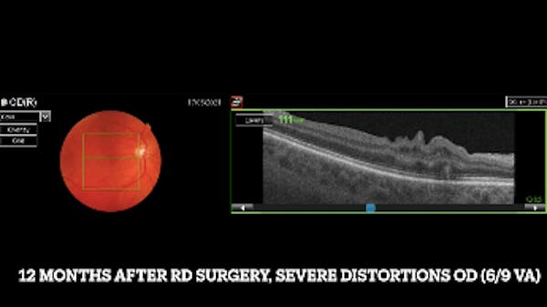 Macular Fold thumbnail
