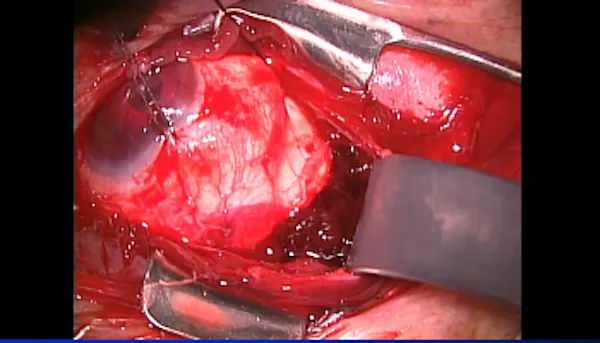 Scleral Rupture thumbnail