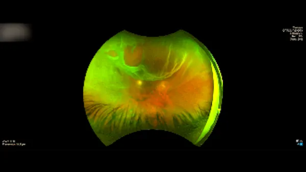 Subretinal Gas thumbnail