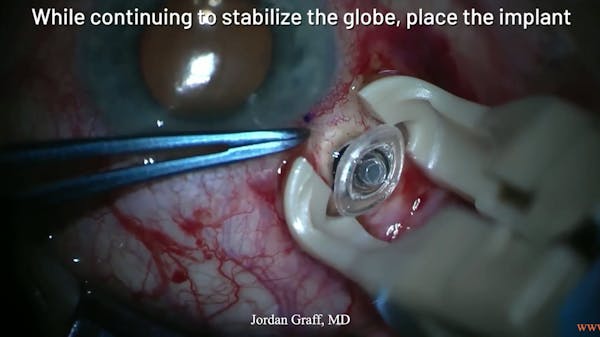 Susvimo: Surgical Pearls & Tricks #3 (Pars plana incision, implant insertion) thumbnail