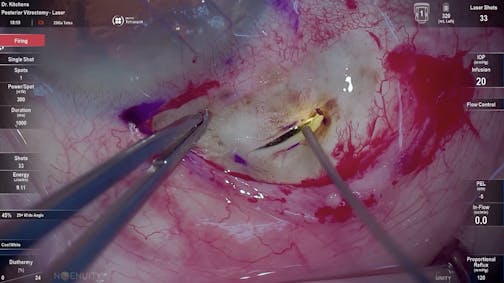 Susvimo: Surgical Pearls - Laser Treatment