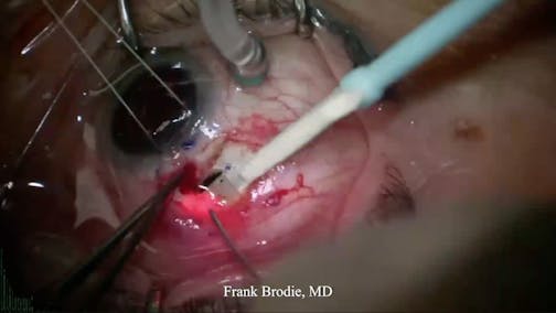 Susvimo: Surgical Pearls & Tricks #2